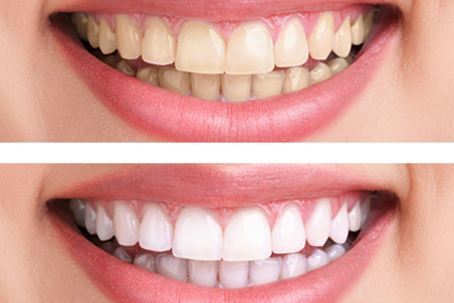 Improve Your Smile By Straightening You Teeth